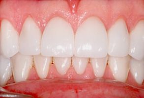 Central Park Dental Aesthetics | Sleep Medicine, Cosmetic Gingival Recontouring and Crown Lengthening