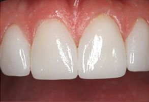 Central Park Dental Aesthetics | TMD, Inlay Restoration and Extractions