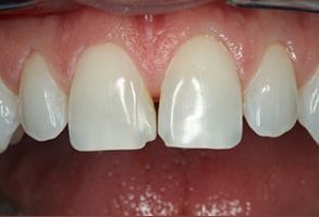 Central Park Dental Aesthetics | Dental Sealants, Same Day Dentistry and TwinLight Periodontal Treatment TPT